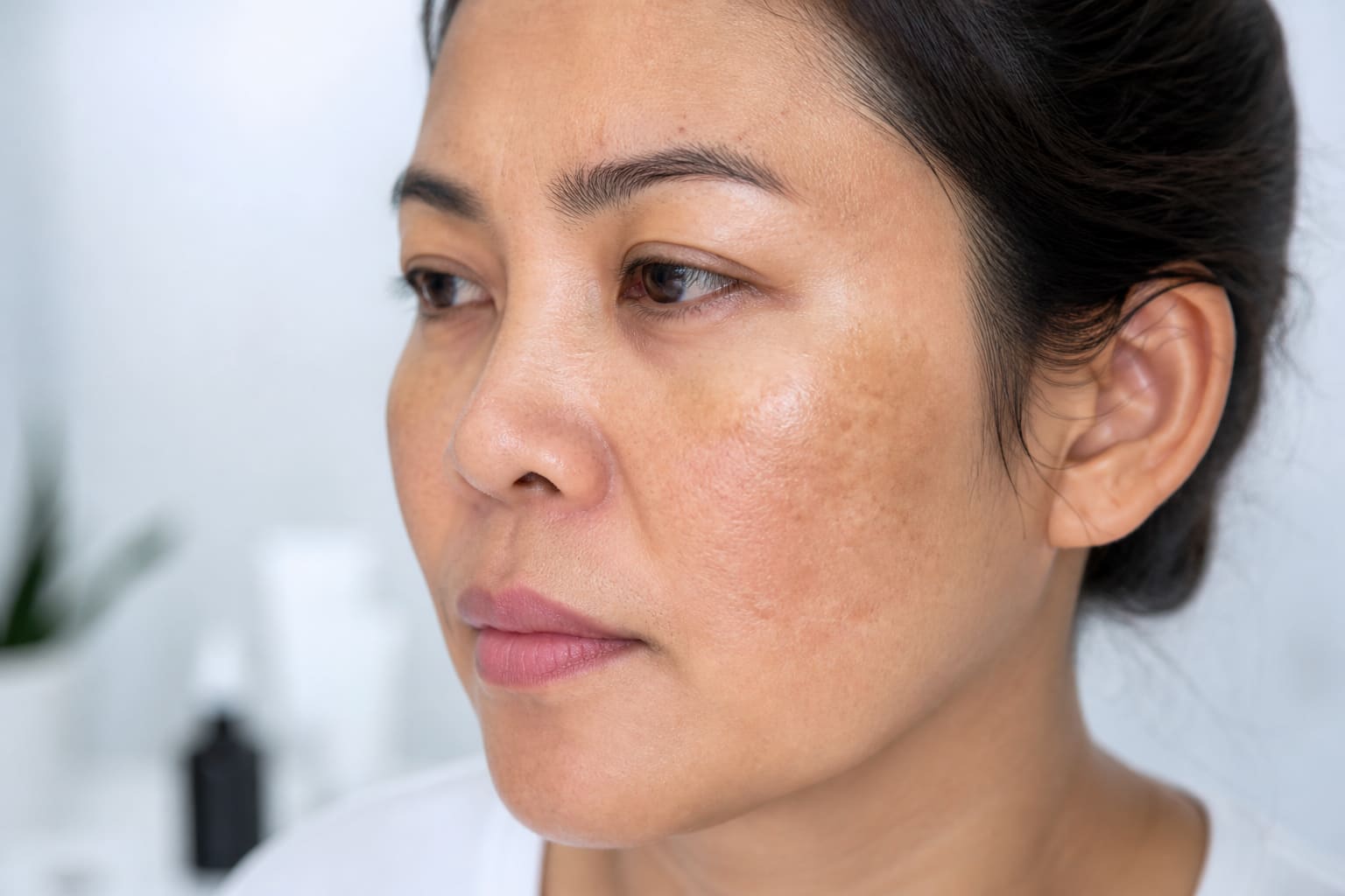 Dark Spots on the Face: Causes and Treatment Options Explained